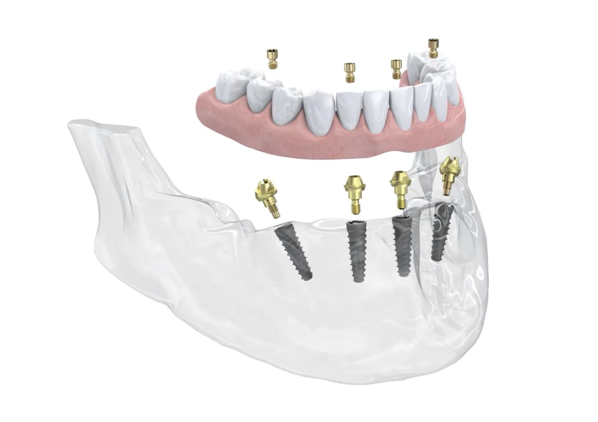 Implantologia dentale