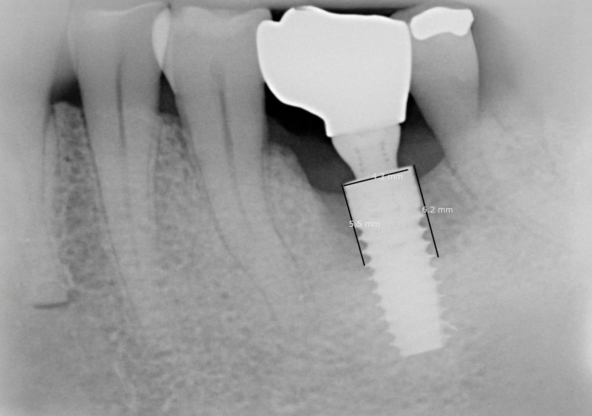 Perimplantite