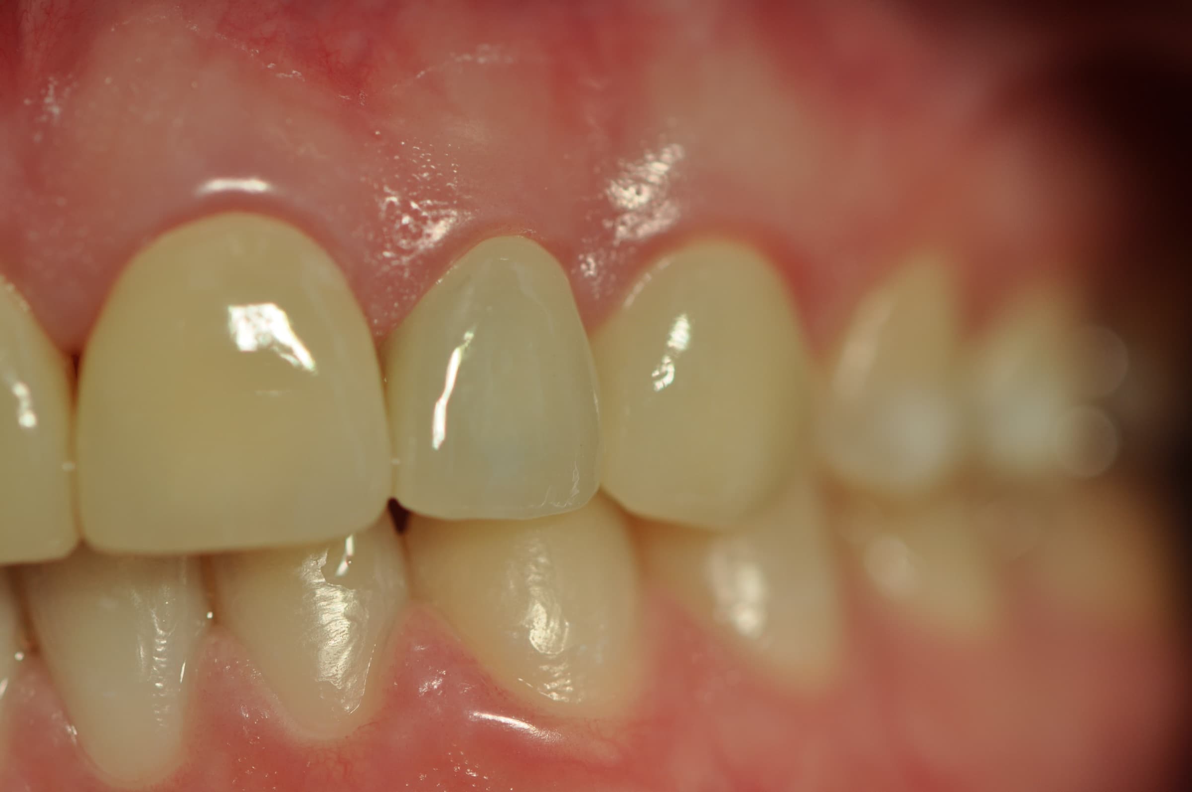 Fixed Dental Prostheses 